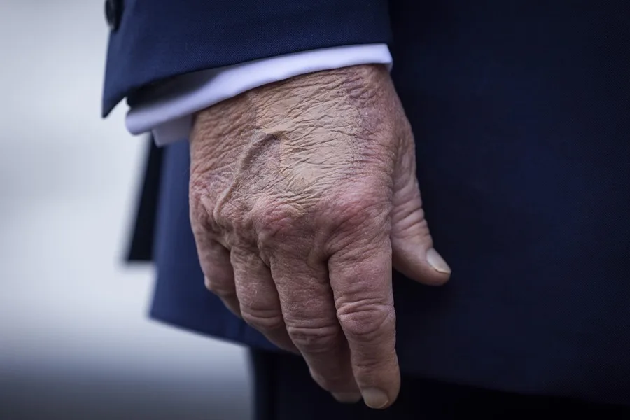 Moretones en las manos de Trump