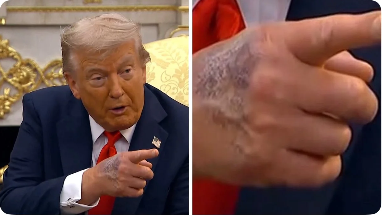 ¿Problemas de salud? Trump revela moretones en su mano