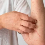 México rebasa cifra histórica de sarampión: así avanza el brote