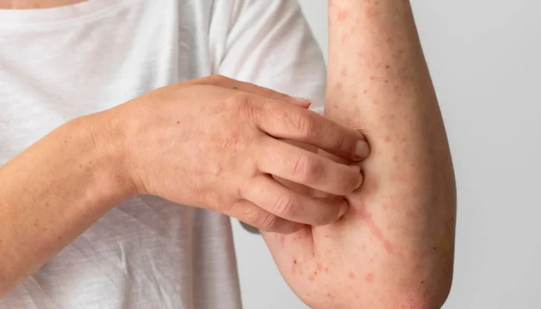 México rebasa cifra histórica de sarampión: así avanza el brote