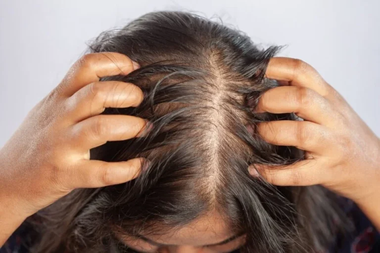 ¡Adiós, alopecia! 5 remedios caseros que pueden salvar tu cabello